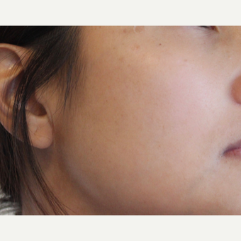 Picosure fractional laser for ethnic skin - Asian skin types after 3583835