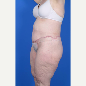 55-64 year old woman treated with Body Lift after 3367426