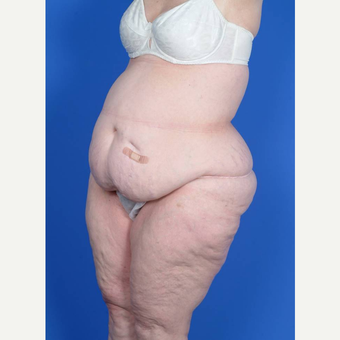 55-64 year old woman treated with Body Lift before 3367426