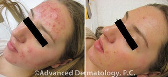 Acleara Acne Clearing System before 1383219