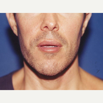35-44 year old man treated with Fat Transfer after 3589043