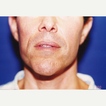 35-44 year old man treated with Fat Transfer before 3589043