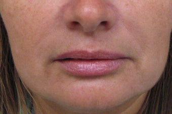 Juvederm® after 479029