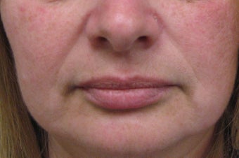 Juvederm® before 479029