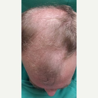 35-44 year old man treated with NeoGraft after 1880433