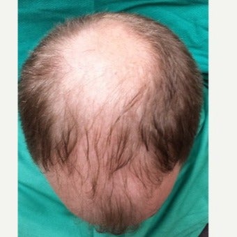 35-44 year old man treated with NeoGraft before 1880433