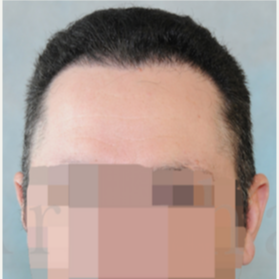 35-44 year old man treated with FUSS Hair Transplant after 3320524