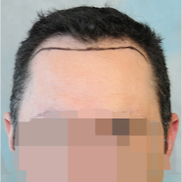 35-44 year old man treated with FUSS Hair Transplant before 3320524