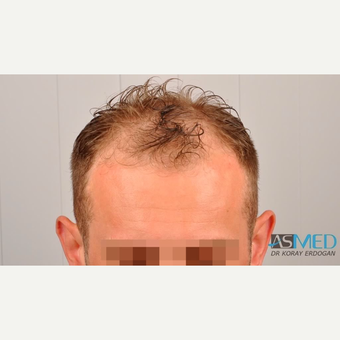 25-34 year old man treated with FUE Hair Transplant before 3091499