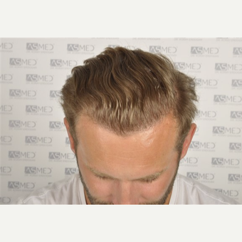 25-34 year old man treated with FUE Hair Transplant after 3091499