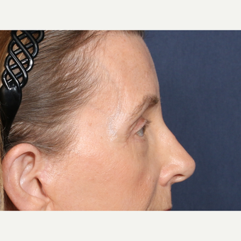 55-64 year old woman treated with Eyelid Surgery (view 2 of 2) after 3226205