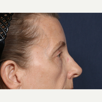 55-64 year old woman treated with Eyelid Surgery (view 2 of 2) before 3226205