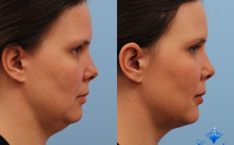 25-34 year old woman treated with Kybella before 3053767