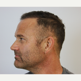 Hair Transplant Result after 3616805