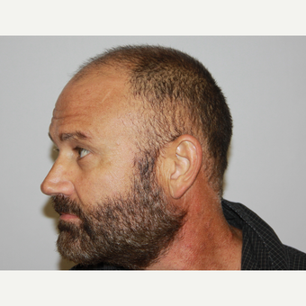 Hair Transplant Result before 3616805