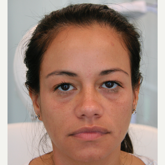 45-54 year old woman treated with Injectable Fillers before 3320139