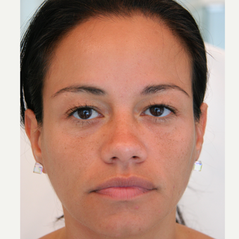 45-54 year old woman treated with Injectable Fillers after 3320139