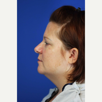 35-44 year old woman treated with Chin Liposuction before 3376952