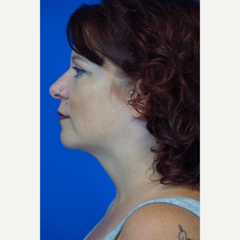 35-44 year old woman treated with Chin Liposuction after 3376952