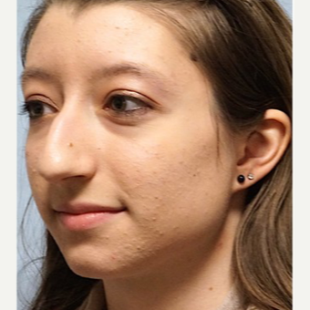 25-34 year old woman treated with Rhinoplasty before 3703410