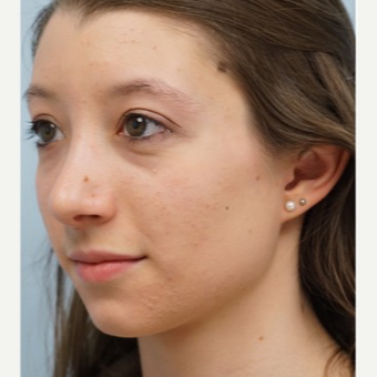 25-34 year old woman treated with Rhinoplasty after 3703410
