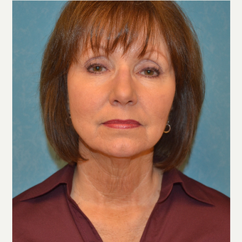 65-74 year old woman treated with Facelift before 3732631