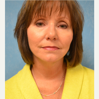65-74 year old woman treated with Facelift after 3732631