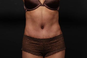 Abdominoplasty (Tummy Tuck) after 437370