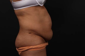 Abdominoplasty (Tummy Tuck) 437370