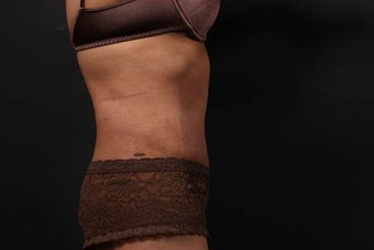 Abdominoplasty (Tummy Tuck) 437370