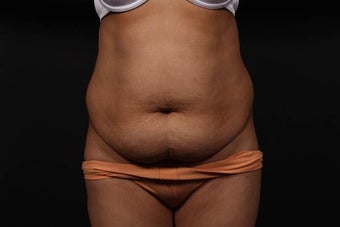 Abdominoplasty (Tummy Tuck) before 437370