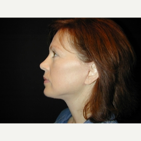 45 year old woman treated with Facelift after 3839626