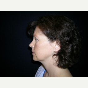 45 year old woman treated with Facelift before 3839626