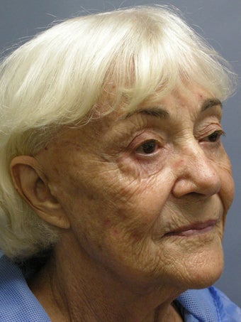 Blue Peel, Chemical Peel 954427