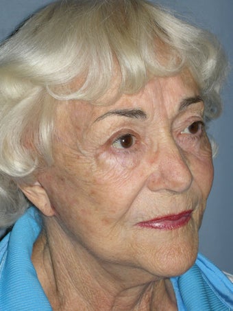 Blue Peel, Chemical Peel 954427