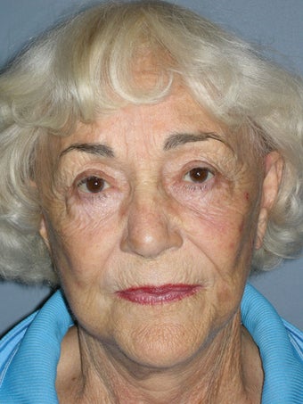 Blue Peel, Chemical Peel after 954427