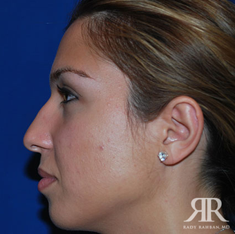 Rhinoplasty before 1357421
