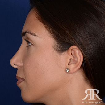 Rhinoplasty after 1357421