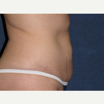 35-44 year old woman treated with Tummy Tuck & Liposuction Hips before 3453664