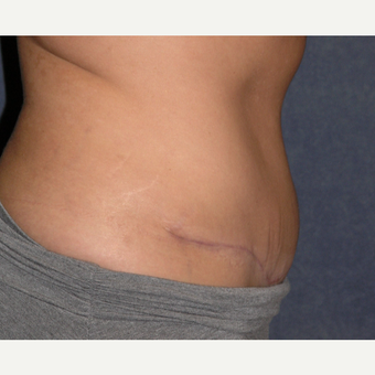 35-44 year old woman treated with Tummy Tuck & Liposuction Hips after 3453664