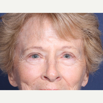 65-74 year old woman treated with Eyelid Surgery after 3180295
