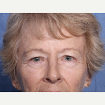 65-74 year old woman treated with Eyelid Surgery before 3180295