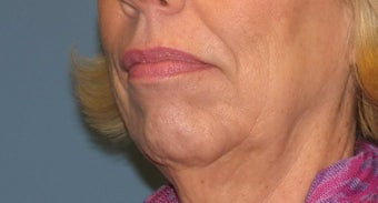 Thermage full face and neck before 1034464