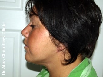 Vaser Lipo + Thread Lift to Eliminate Double Chin after 947505