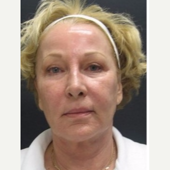 55-64 year old woman treated with Non Surgical Face Lift before 3181394
