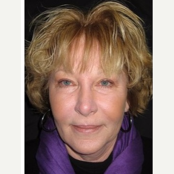 55-64 year old woman treated with Non Surgical Face Lift after 3181394