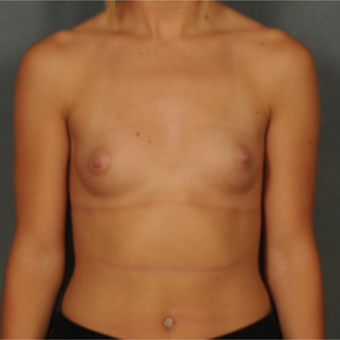 18-24 year old woman treated with Breast Implants before 3583105