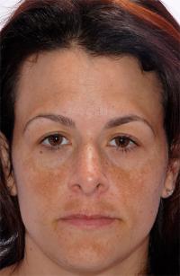 Chemical Peel before 905415