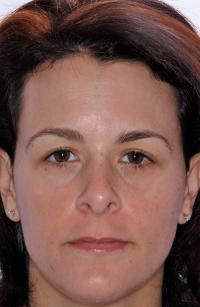 Chemical Peel after 905415
