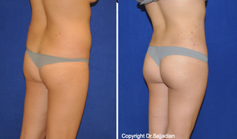 Butt Augmentation before 1262618